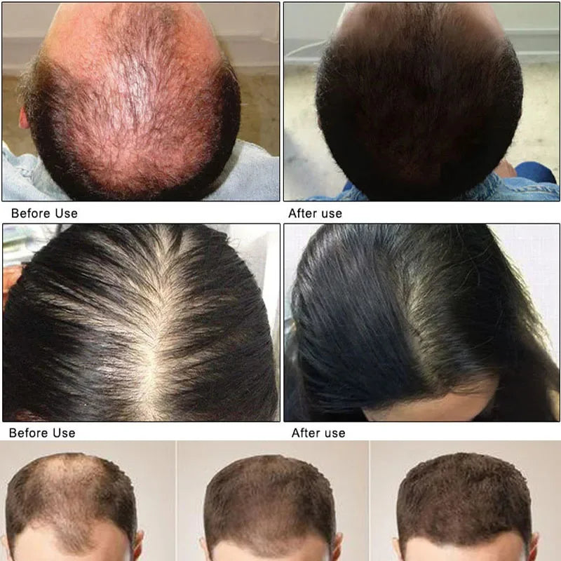 Ginger Hair Growth Essential Oil Anti-loss Hair Regrowth Serum Fast Growth Prevent Baldness Treatment Alopecia Hair Care Product